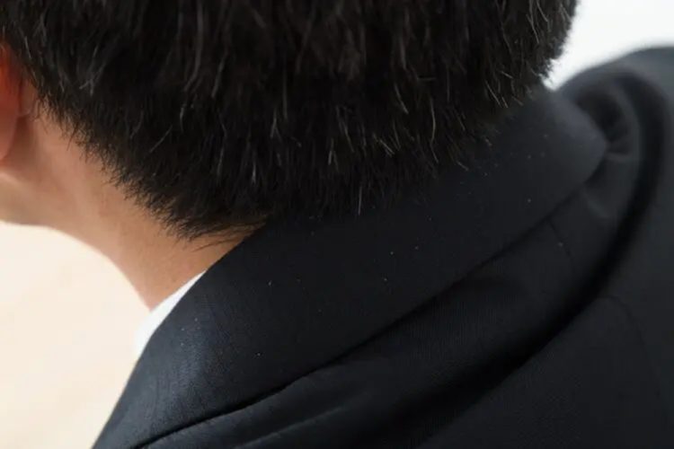 フケの正体は？