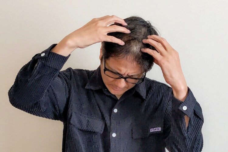 女性は男性の薄毛をどう見ている？リアルな本音をチェック