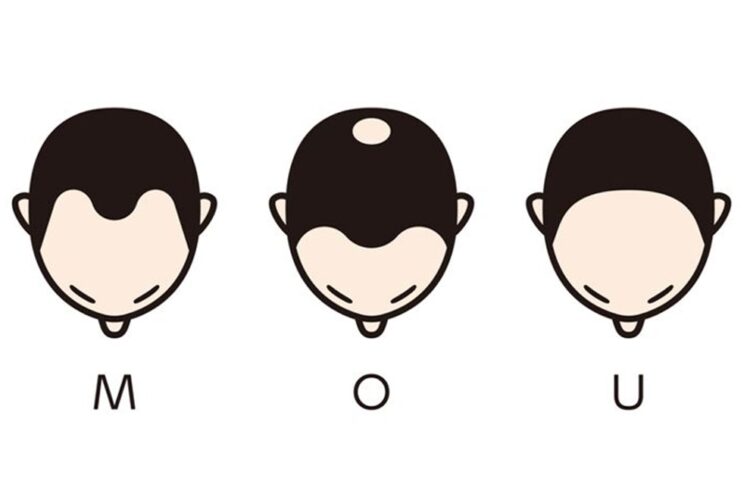 薄毛の進行タイプ